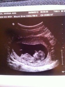 ultrasound (13 weeks)